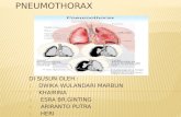 Pneumothorax powerpoint