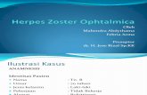Herpes Zoster Ophtalmica