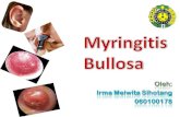 Myringitis Bullosa