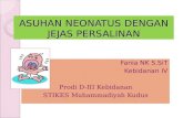 Caput Succedaneum materi askeb STIKES Muhammadiyah Kudus