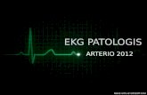 Ekg Patologis