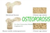 Penyuluhan Osteoporosis