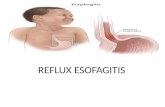 Reflux Esofagitis