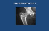 212879805 Fraktur Patologis Presentasi