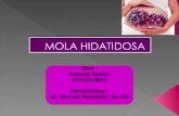 205988621 Referat Mola Hidatidosa 1