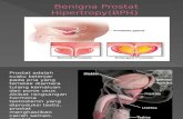 Benigna Prostat Hiperplasia(BPH)