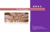 Vitiligo - · PDF fileVitiligo dapat dipicu oleh beberapa hal: 1. Stress 2. Sistem imun yg buruk 3. Kelenjar tiroid ... tidak lebih dari 1 menit. Jika takut kebakar, seminggu sekali