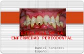 Etiologia de la enfermedad periodontal