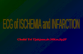 ECG, Ischemia,MCI.ppt