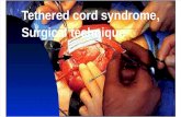 Tethered Cord Syndrome