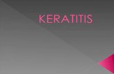 Keratitis Ppt presentasi