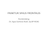 Fraktur sinus frontal